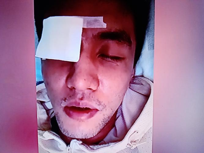 男子误将502滴右眼？男子右眼误滴502胶水紧急求助！