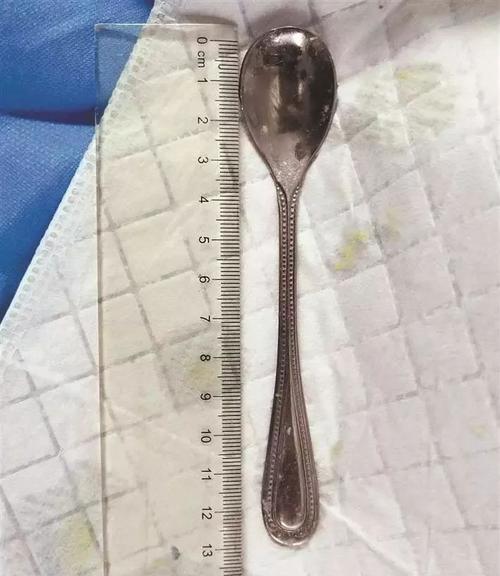误吞勺子半年后发现？误吞勺子半年后的惊人发现？