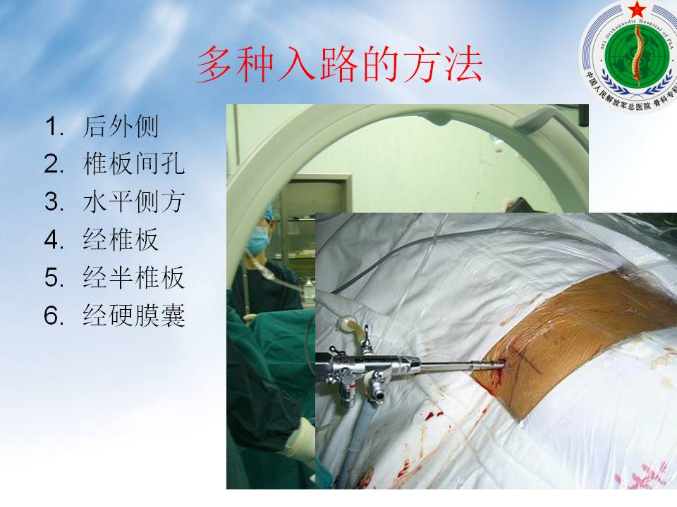 脊柱内镜诊疗技术备案
