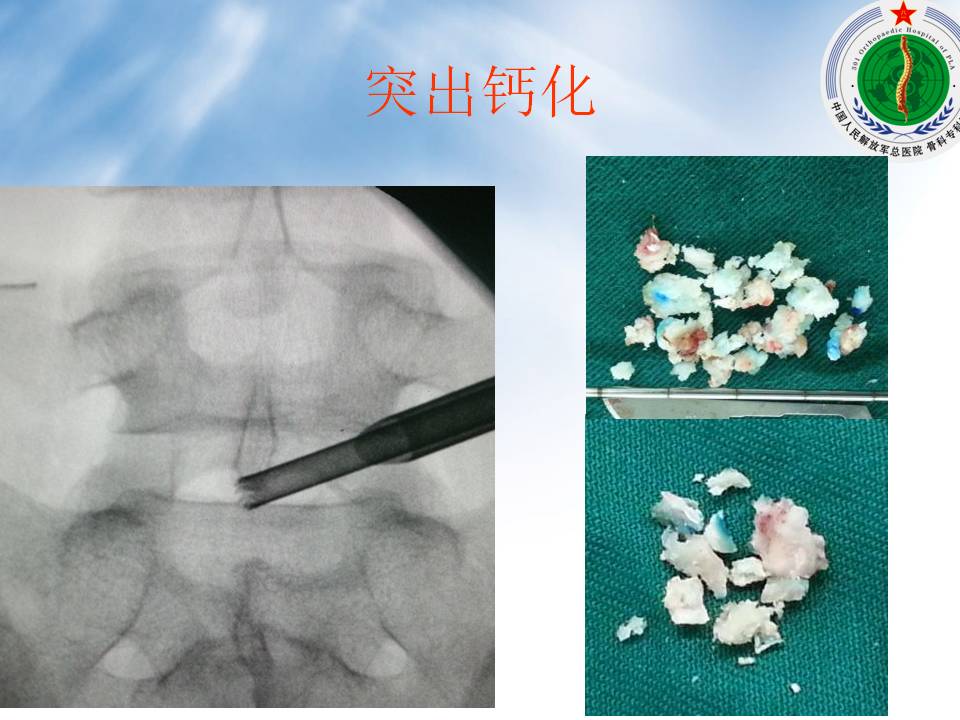 脊柱内镜诊疗技术备案